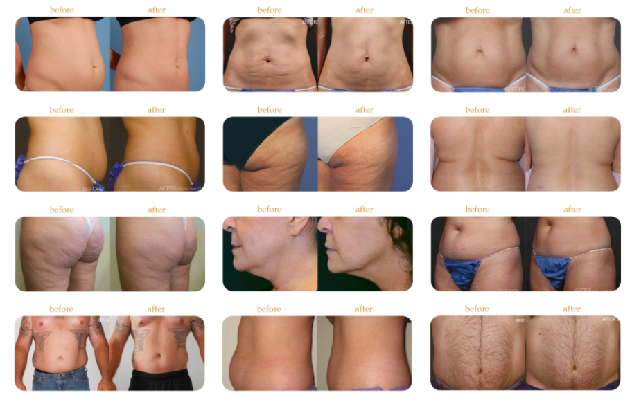 Does Noninvasive, Nonsurgical Body Sculpting Work?